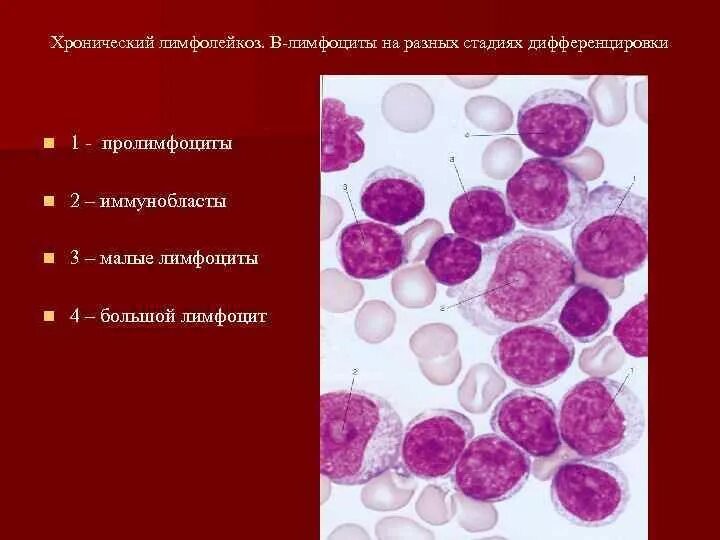 Лимфоцит хронический лейкоз. Тени Боткина Гумпрехта. В -лимфоциты хронический лимфолейкоз. Острый лимфобластный лейкоз мазок. B хронический лимфолейкоз