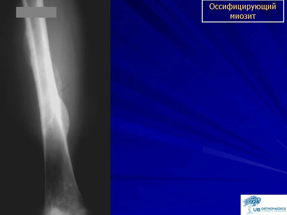 Оссифицированный миозит. Оссифицирующий миозит. оссифицирующий миозит рентген. оссифицирующий миозит коленного сустава. оссифицирующий миозит плеча.