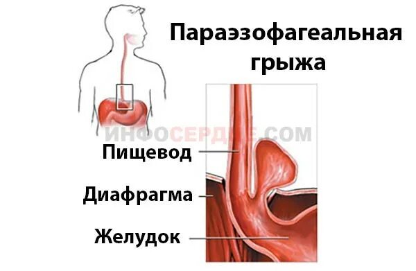 Жгучие боли в пищеводе. Параэзофагеальная грыжа диафрагмы. Параэзофагеальная грыжа пищеводного отверстия диафрагмы. Параэзофагеальная кишечная грыжа. Параэзофагеальный грыжа рентген Параэзофагеальная.