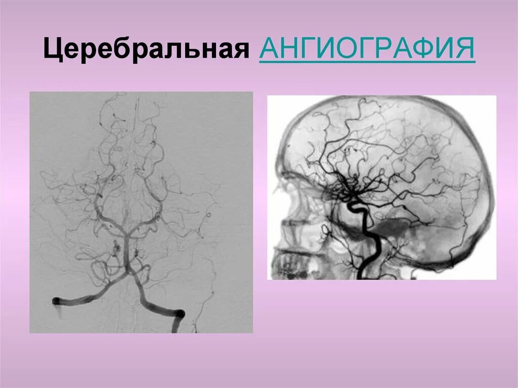 Сосуды головного мозга норма. Селективная ангиография сосудов головного мозга. Ангиография артерий и вен головного мозга. Церебральная ангиография сосудов головного мозга. Церебральная ангиография анатомия.