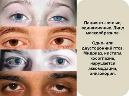 Мидриаз характерен для