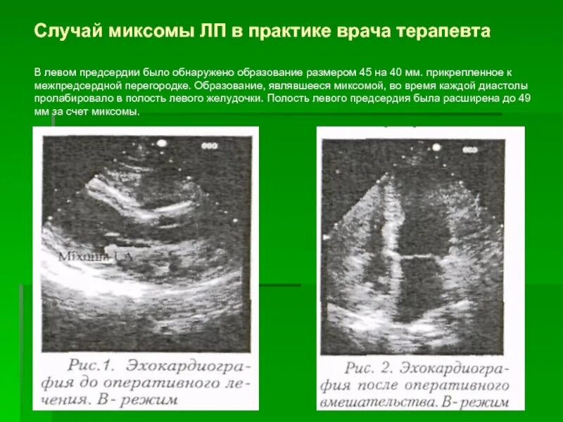 Образование левого предсердия. Миксома левого предсердия на ЭХОКГ. Миксома правого желудочка.