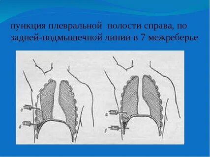 Прокол при пневмотораксе