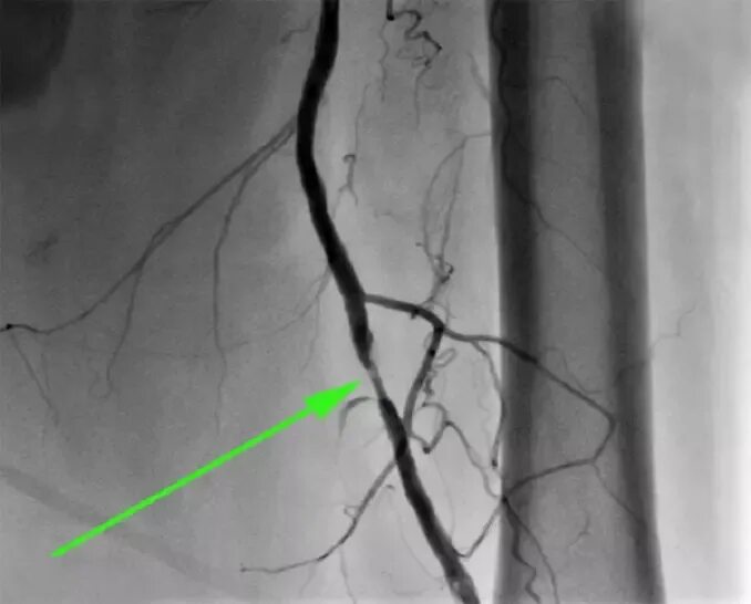 Тромбоз нижних конечностей ангиография. Ангиограмма сосудов нижних конечностей. Магнитно-резонансная ангиография сосудов нижних конечностей. Коронарография сосудов нижних конечностей. Стеноз прямой