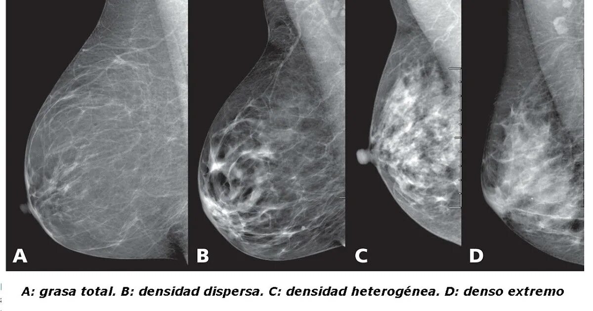 Доле груди. Фиброзно кистозная мастопатия молочной железы bi-rads-4a. Фиброзно-кистозная ткань молочной железы. Плотность молочной железы на маммографии. Фиброзно-кистозная мастопатия молочных желез на маммографии.