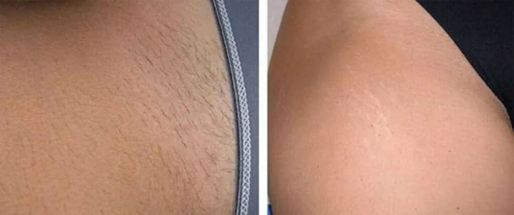 Глубокая депиляция интимной зоны. Фотоэпиляция лазерная глубокое бикини. фотоэпиляция зоны глубокого бикини. лазерная эпиляция бикини элос. фотоэпиляция глубокое бикини.