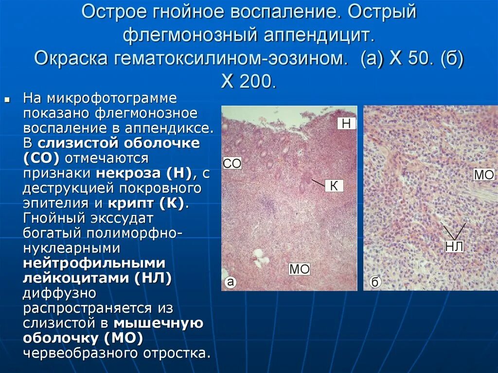 Флегмонозно-язвенный аппендицит гистология. Флегмонозно язвенный аппендицит микропрепарат. Острый катаральный аппендицит гистология. Микропрепарат острый Гнойный аппендицит флегмонозно-язвенный. Гнойную степень