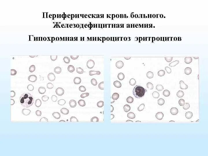 Гипохромия железодефицитная анемия. Микроцитоз при железодефицитной анемии. Гипохромия микроцитоз. Железодефицитная анемия пойкилоцитоз. Мазок крови больного с железодефицитной анемией.