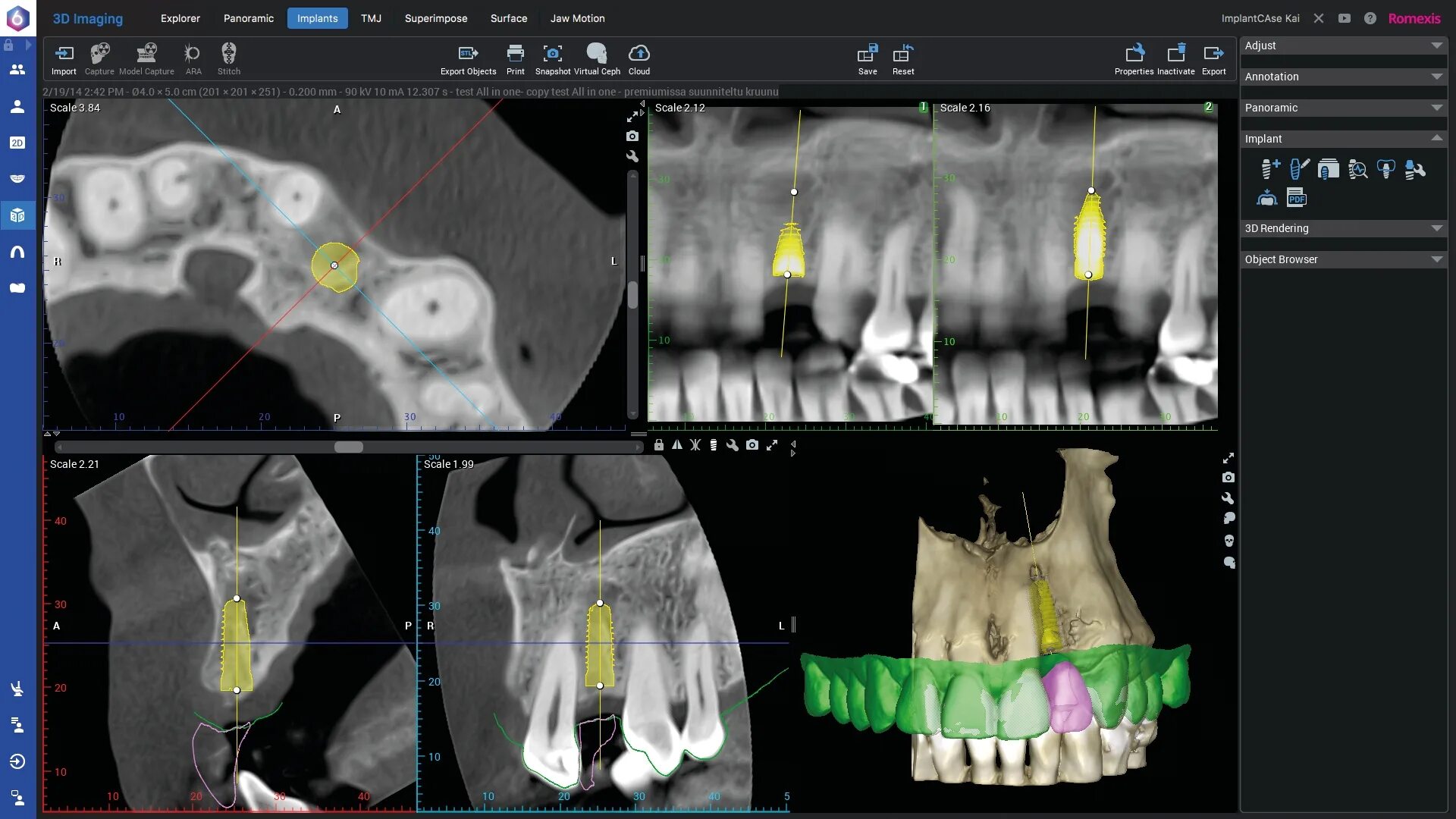 Planmeca romexis viewer. Кт planmeca promax 3d. томограф планмека. сканирование интраоральным сканером. сканнер planmeca.