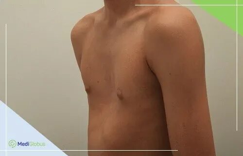 Воронкообразная деформация грудной клетки (pectus excavatum). Заболевание грудной клетки хирургия. Заболевание грудной клетки хирургия. Заболевание грудной клетки хирургия. Заболевание грудной клетки хирургия.