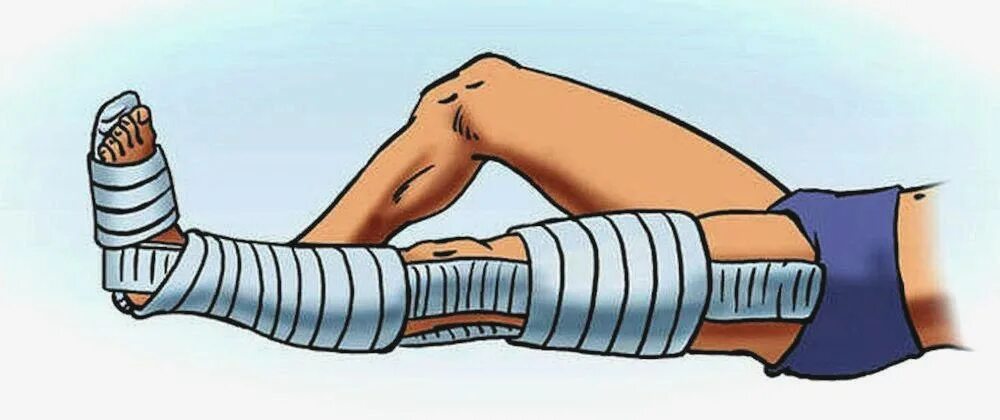 При переломах костей конечностей накладывается ш. Шина на месте перелома. Перелом голени наложение шины. Правила наложения шины при переломе голени. Шина крамера перелом костей голени.