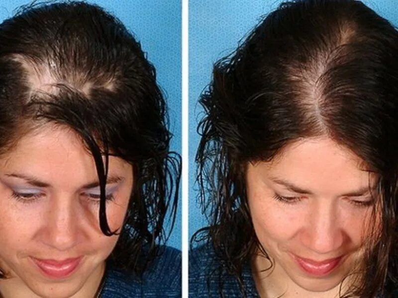 Эффект после лечения. Мезотерапия волос до и после. Мезотерапия волос головы до и после. Мезотерапия при облысении. Выпадение волос до и после.