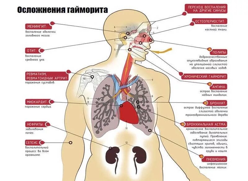 Может ли гайморит перейти в менингит. Осложнения от гайморита. осложнения острого син.