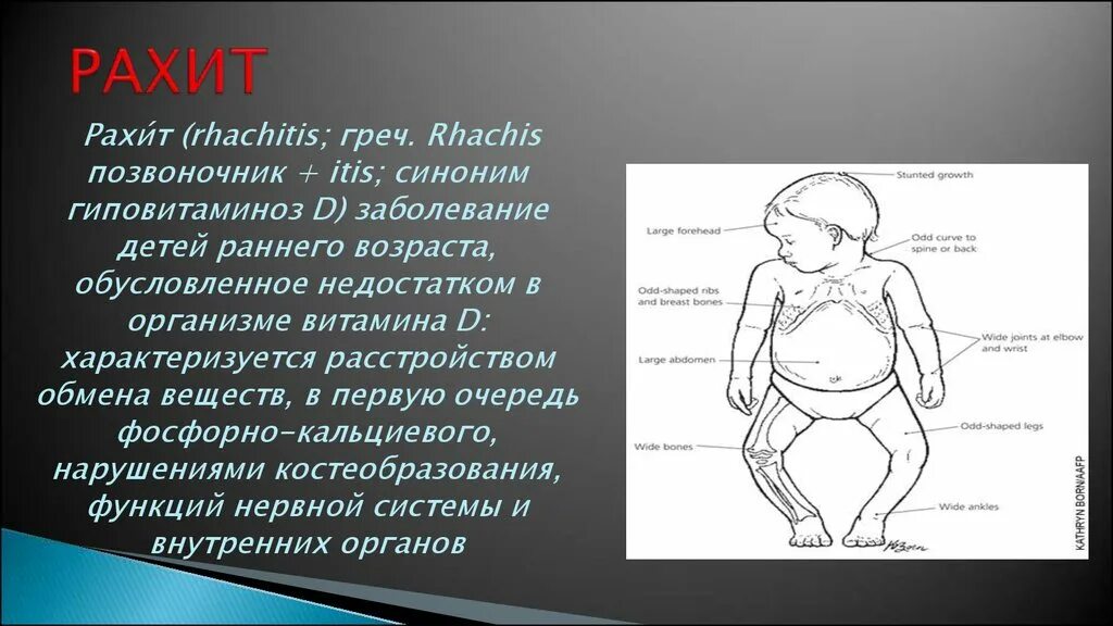 Рахит (дефицит витамина d). Заболевания детей раннего возраста: рахит. Рахит у детей раннего возраста. Рахит у детей клинические рекомендации. Рахит в 6