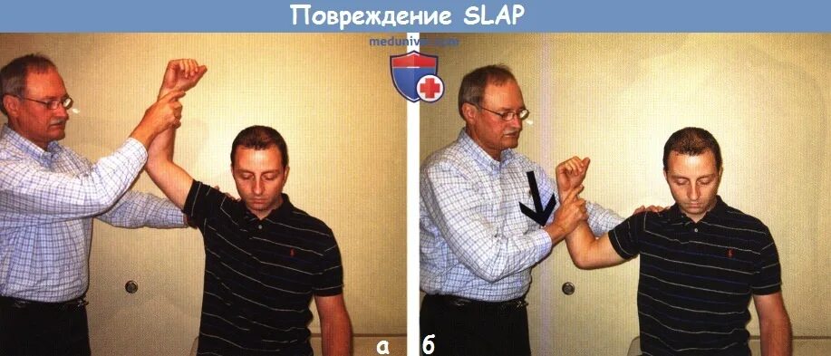 Slap разрыв суставной губы. Слап повреждение плечевого сустава.
