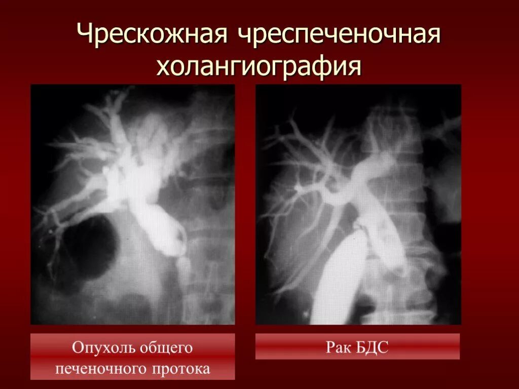 Чреспеченочная холангиография. Чреспеченочная холангиография. Чрескожная чреспеченочная холангиография. Чрескожная через печеночная холангиография. Чреспеченочная холангиография.