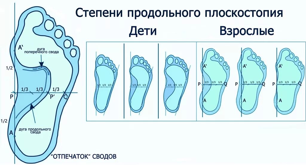 Плоскостопие 3 степени сколько градусов. Плоскостопие 1, 2, 3 степени. Продольное плоскостопие 2 степени. Плоскостопие 2 степени угол свода стопы. Продольное и поперечное плоскостопие 1 и 2 степени.