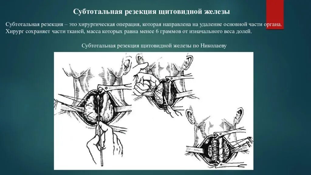 Операция на щитовидной отзывы. Субтотальная резекция щитовидной. Субтотальная резекция железы. Субтотальная резекция щитовидной железы по Николаеву. Субтотальная резекция околоушной железы.