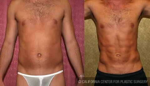 Male Liposuction Abdomen Before & After Patient #5614.