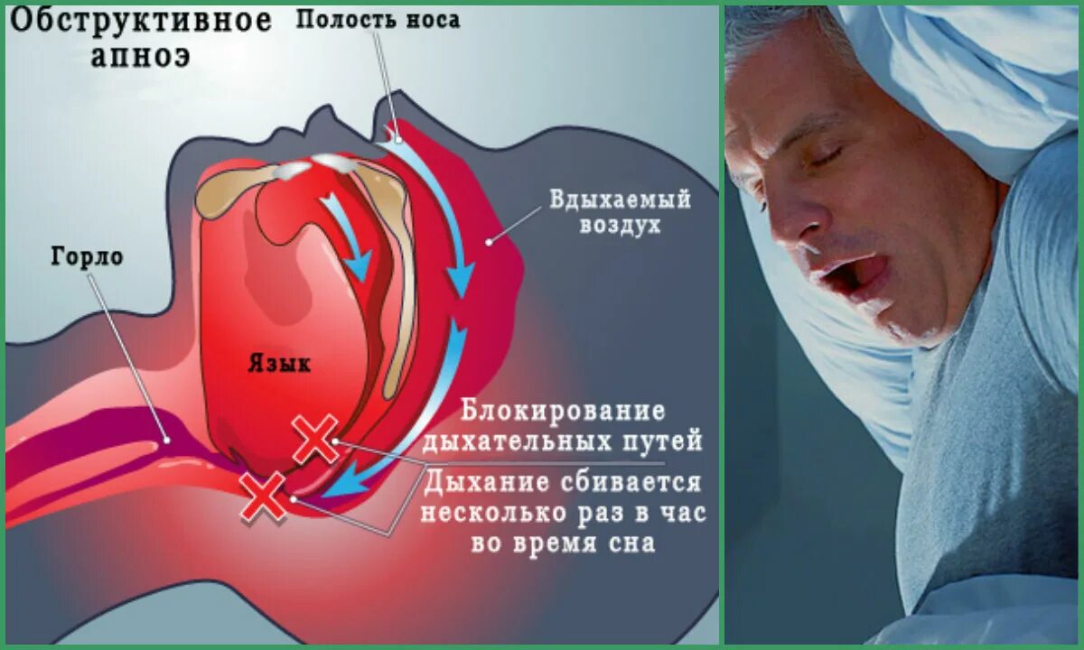 Заболевание апноэ во сне. Центральное сонное апноэ. Обструктивное апноэ.