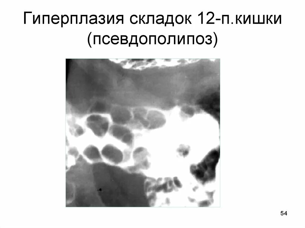 Фолликулярная гиперплазия желудка. Фолликулярная гиперплазия. Фолликулярная гиперплазия желудка. Фовеолярная гиперплазия гистология. Атрофический гастрит гистология.