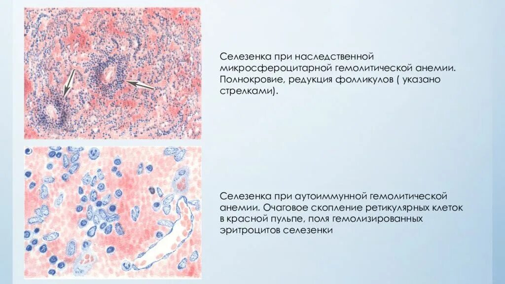 Апластическая анемия микропрепарат описание. Селезенка при гемолитической анемии. Надпочечник при ГБН микропрепарат. Полнокровие патанатомия.