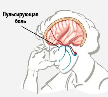 Шейная мигрень