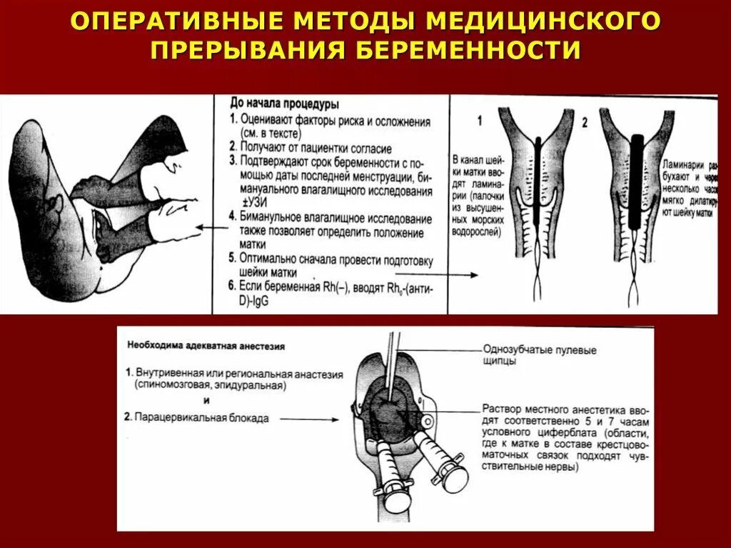 Блокада инструкция. Парацервикальная блокада. Местная анестезия матки. Методы прерывания беременности презентация. Парацервикальная анестезия в гинекологии.