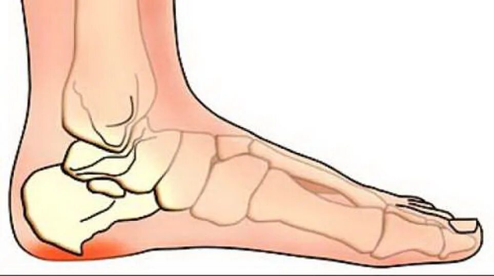 Плантарный фасциит рентген. Плантарный фасциит пяточной кости. Пяточно подошвенный фасциит. Болит пятка на правой ноге причины