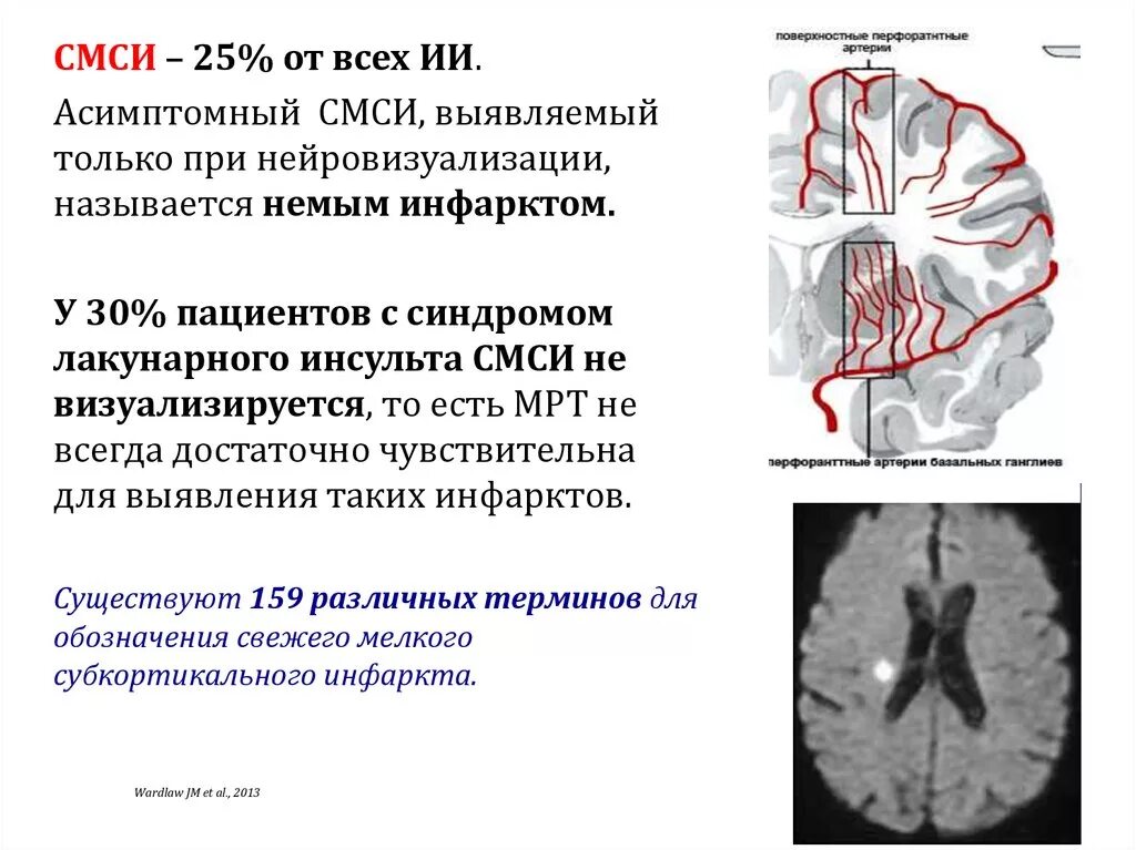 Левая средняя мозговая артерия инсульт. Лакунарный инсульт патогенез. Лакунарный инсульт мрт. Лакунарный Подтип ишемического инсульта. Лакунарный ишемический инсульт.