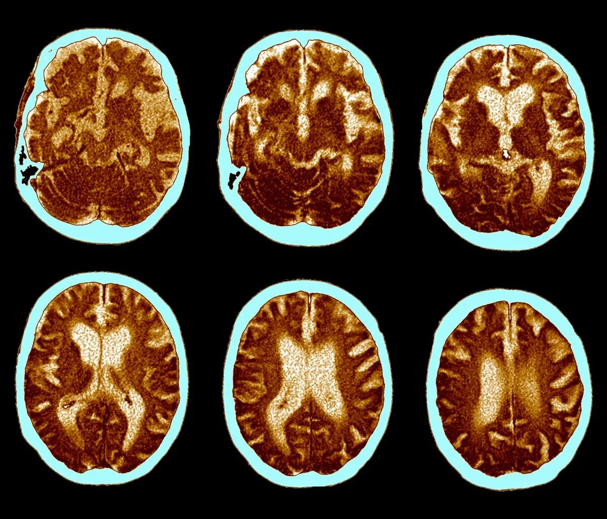 Brain disorder. Мозг здорового человека и Альцгеймера. Болезнь Альцгеймера. Болезнь Альцгеймера мозг.