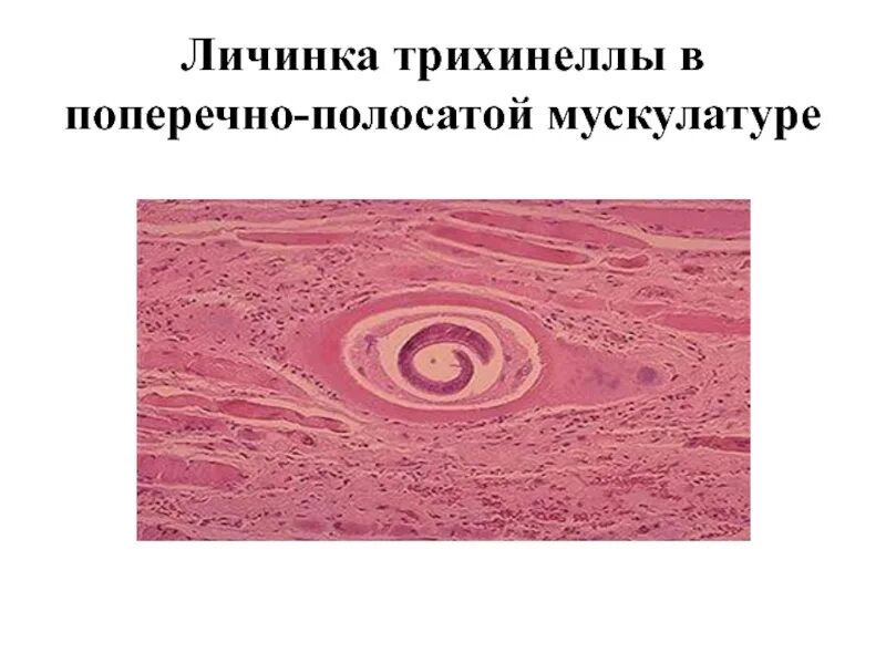 Личинка трихинеллы в поперечно-полосатой мускулатуре. Трихинелла микропрепарат. Личинка трихинеллы в мышцах препарат. Инкапсулированные личинки трихинеллы в мышцах.