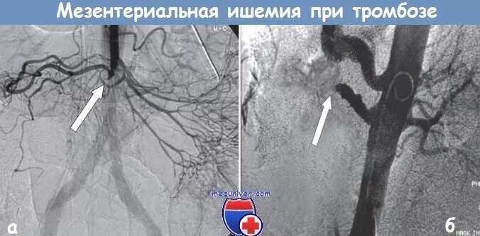 Мезентериальная ишемия. Тромбоз мезентериальных сосудов на кт. Ангиография при мезентериальном тромбозе. Ангиография мезентериальных сосудов. Острая мезентериальная ишемия.