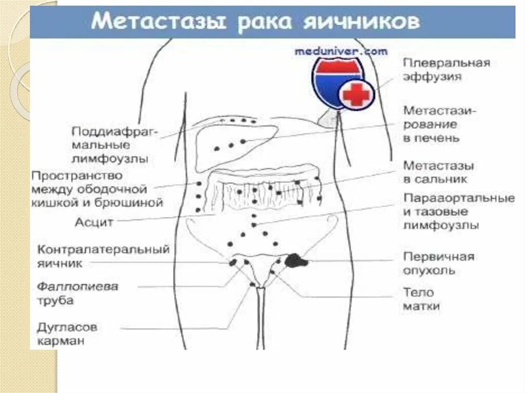 Локализация боли в яичниках. Боль яичников локализация. Локализация боли при яичниках. Болит правая сторона яичников