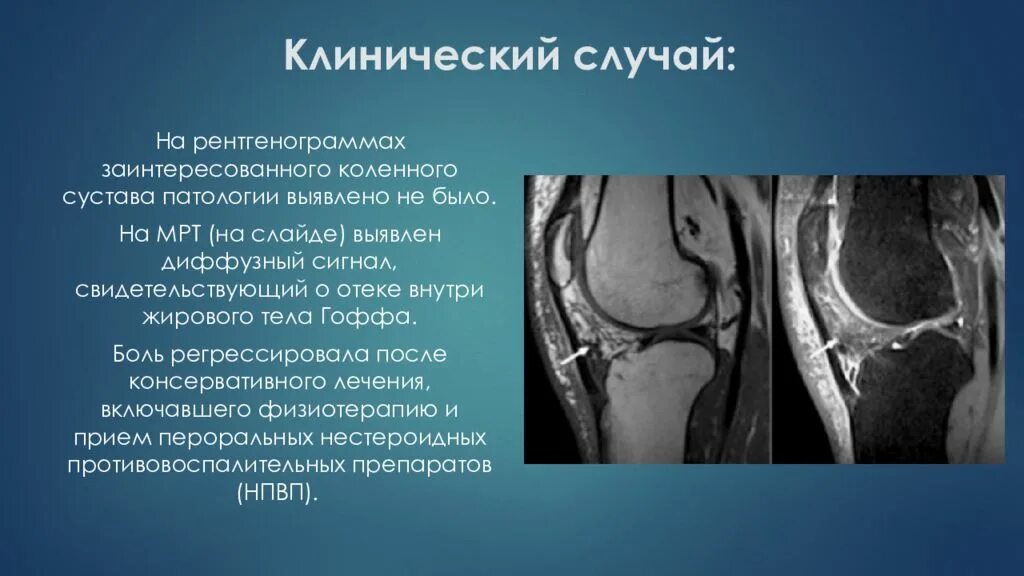 Отек гоффа коленного сустава. Липоартрит Гоффа коленного сустава. Болезнь тела Гоффа мрт. Гипертрофия жирового тела Гоффа. Гипертрофия Гоффа коленного сустава.