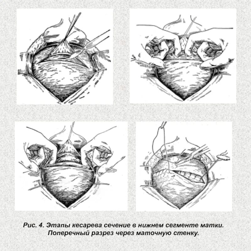 Сколько по времени операция кесарево сечения. Методика операции.кесарева сечения. Этапы операции при кесарево сечении. Схема этапов операции кесарева сечения. Экстраперитонеальное кесарево сечение.