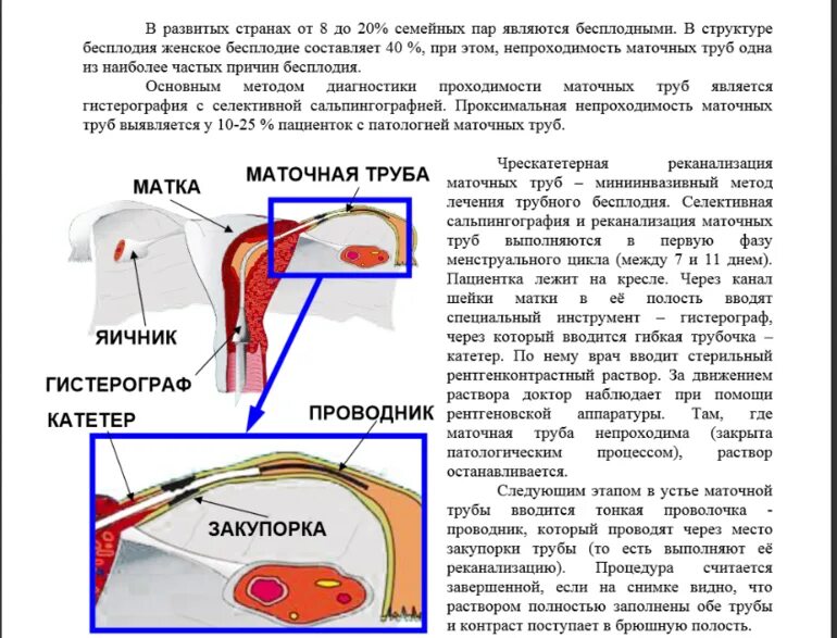 Реканализация маточных труб. Как делают проверку маточных труб. Методы проходимости маточных труб. Проверка маточных труб на проходимость как называется процедура. Операции матки и трубы