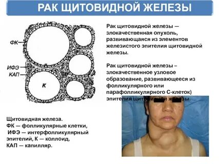 Объемное образование щитовидной железы