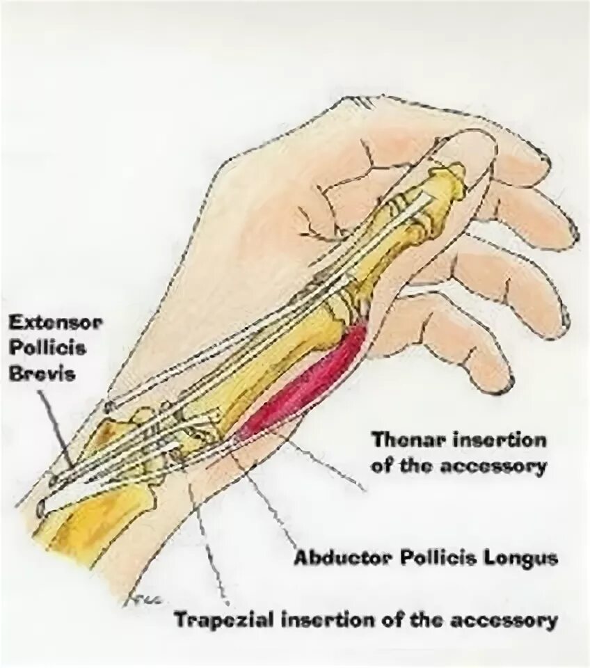 Сколько заживает сухожилие. Сухожилие разгибателя пальца. Отрыв сухожилия разгибателя пальца. Сухожилие разгибателя большого пальца кисти. Разрыв разгибателя 1 пальца кисти.