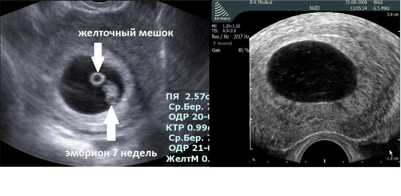 Яйцо растет эмбриона нет