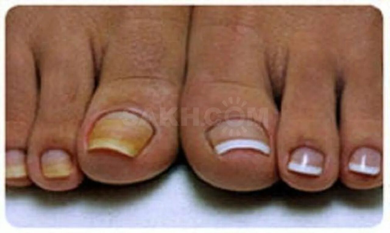 Педикюр с грибком ногтей. Наращивание проблемных ногтей на ногах. Педикюр на проблемных ногтях.