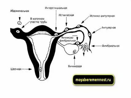Трубы матки