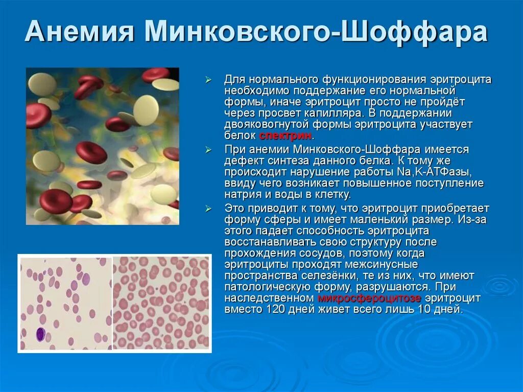 Микросфероцитарной анемией -болезнь(Минковского Шоффара)?. Анализ крови при болезни Минковского-Шоффара. Основная причина микросфероцитарной гемолитической анемии. Наследственный сфероцитоз (анемия Минковского-Шоффара).