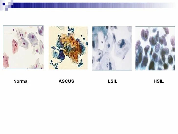 Lsil интраэпителиальное поражение низкой