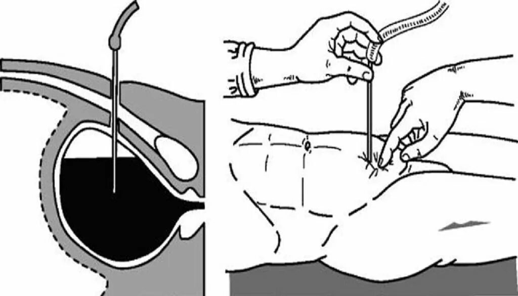 Снять катетер у мужчины. Цистостома мочевого пузыря катетер. Прокол (капиллярная пункция) мочевого пузыря. Катетеризация мочевого пузыря и пункция. Надлобковая капиллярная пункция.