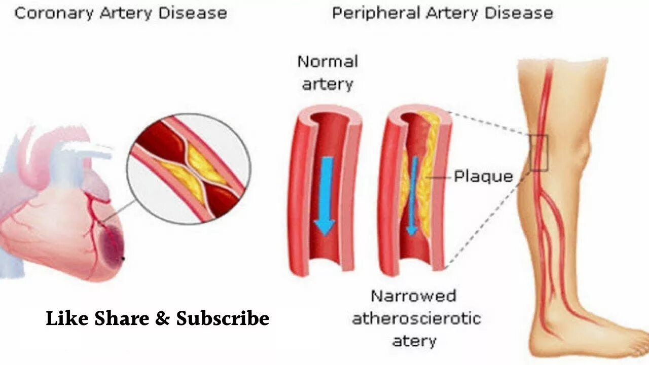 Тромбоз артериальных сосудов. Артериальный тромбоз конечностей. Тромбоз и эмболия и атеросклероз. Эмболия сосудов конечностей. Тромбоз артерий лечение