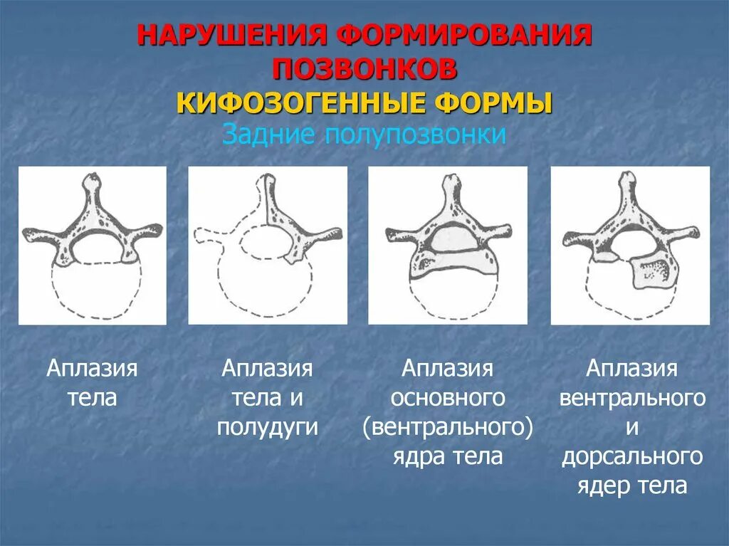 Аномалии развития позвоночника. Аномалии развития позвонков. Нарушение формирования позвонков. Варианты развития позвонков. Варианты развития тел позвонков.