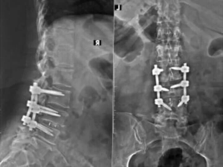 Операция фиксация позвоночника. Транспедикулярная фиксация l5-s1 позвонков. Транспедикулярная фиксация l3 l4. Спондилолистез ТПФ. Транспедикулярная фиксация позвоночника l4-l5.