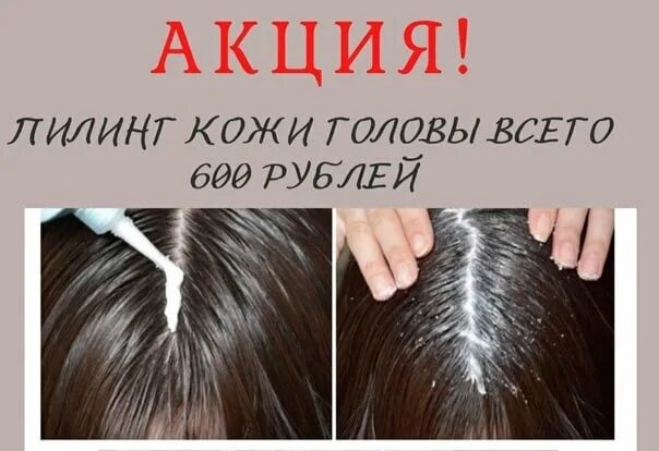 Пилинг для кожи головы для чего. Пилинг для кожи головы. пилинг для кожи головы b. пилинг кожи головы до и после. пилинг волос в салоне.