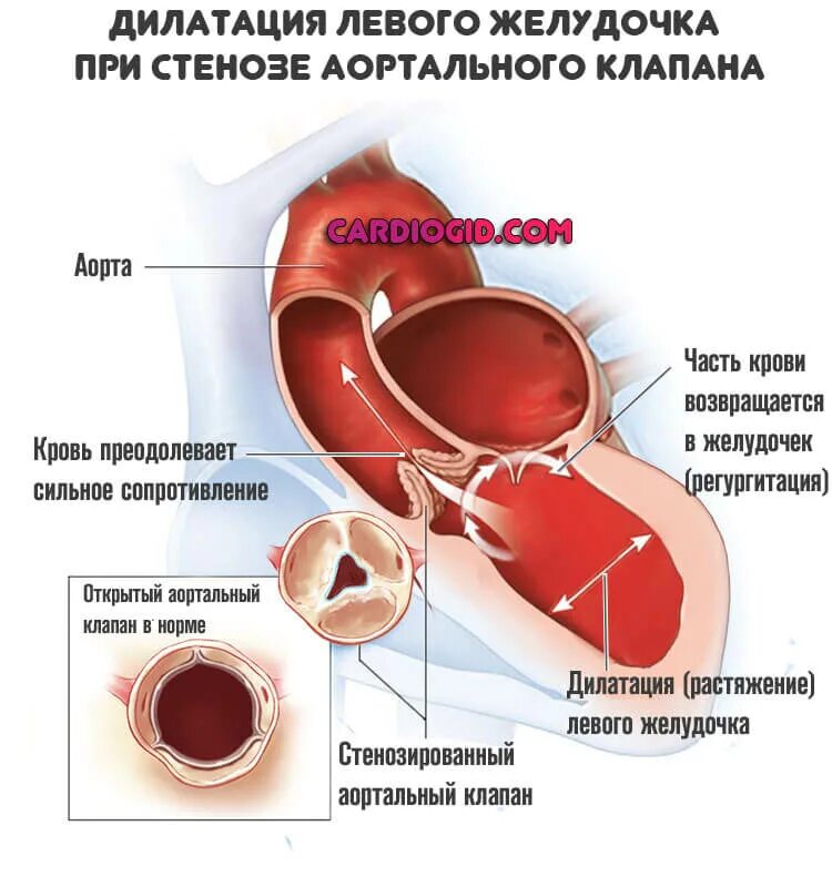 Признаки порока аортального клапана. Порок сердца стеноз аортального клапана. Пороки сердца аортальный стеноз и недостаточность. Стеноз отверстия аортального клапана. Левое предсердие увеличено